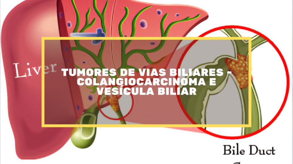 Tumores De Vias Biliares Colangiocarcinoma E Vesícula Biliar