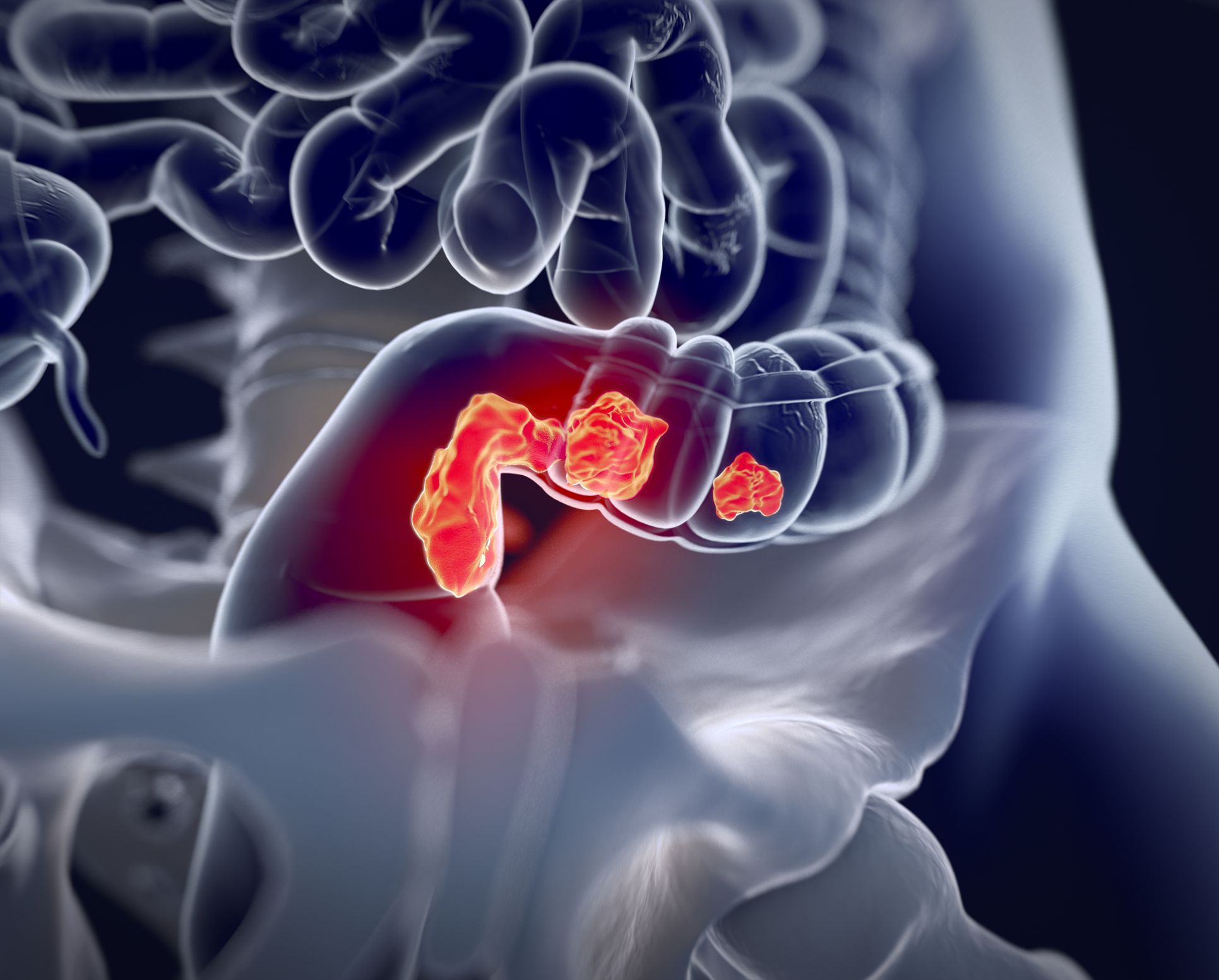 Tratamento Curativo Do Câncer De Reto Oncologia Do CÓlon