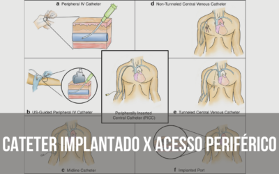 Cateter Implantado X Acesso Periférico