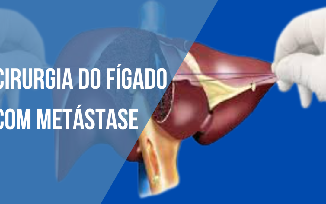 Cirurgia Do Fígado Com Metástase