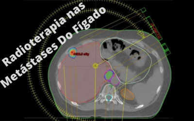 Radioterapia nas Metástases Do Fígado