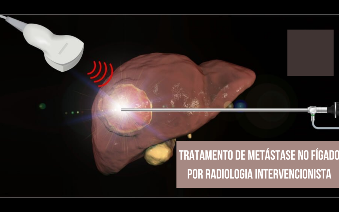 Tratamento de Metástase No Fígado Por Radiologia Intervencionista