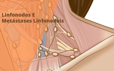 Linfonodos E Metástases Linfonodais