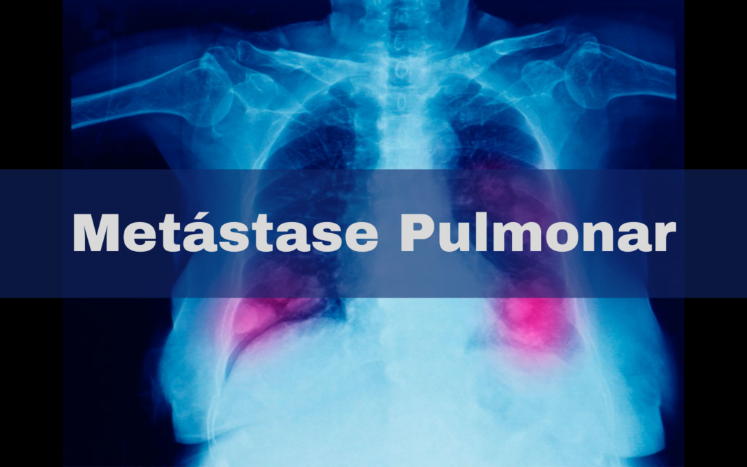 Metástase Pulmonar