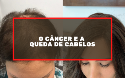 O Câncer e a Queda De Cabelos